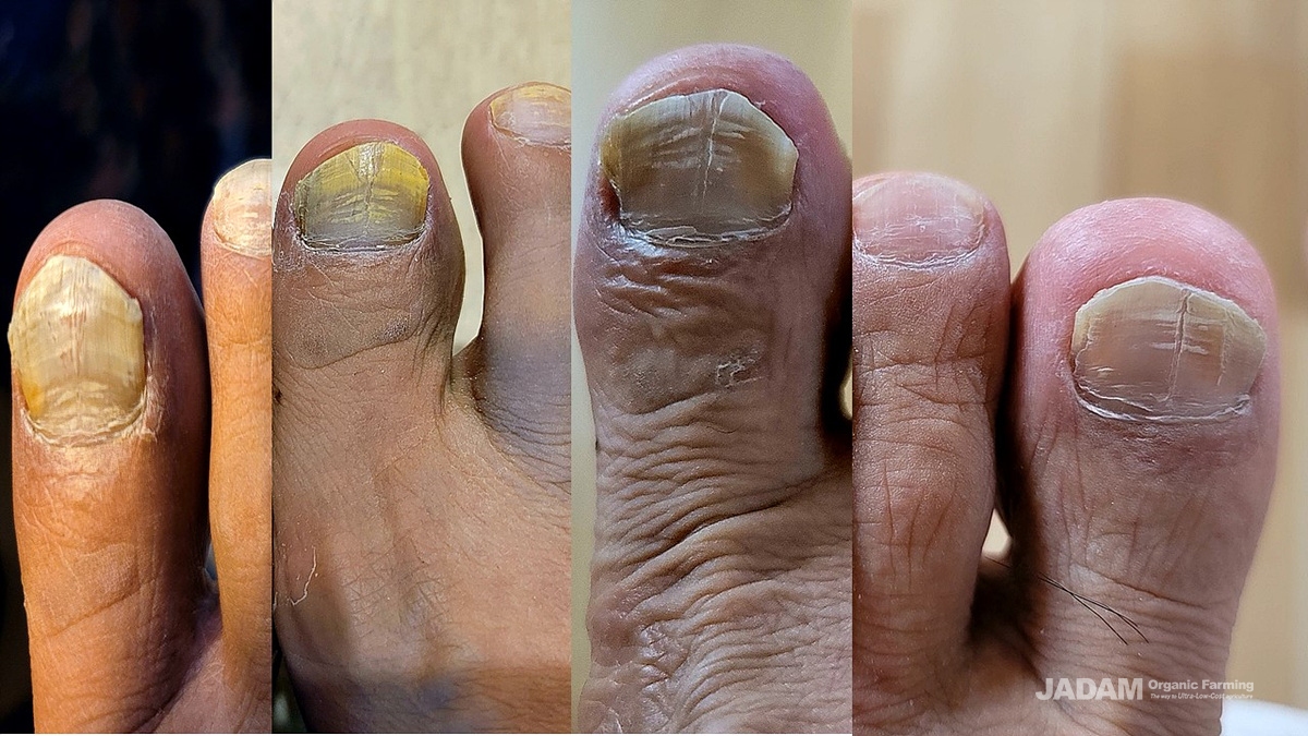It is confirmed with the eyes that the toenails are gradually getting healthier.