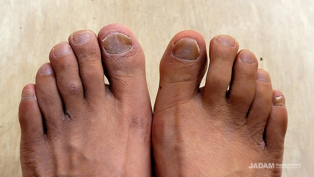 After cutting off the dead toenails, you can see a healthy condition of nails.